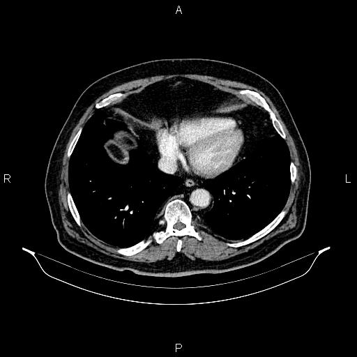 Abdominal aortic aneurysm (Radiopaedia 83094-97462 Axial renal cortical phase 56).jpg