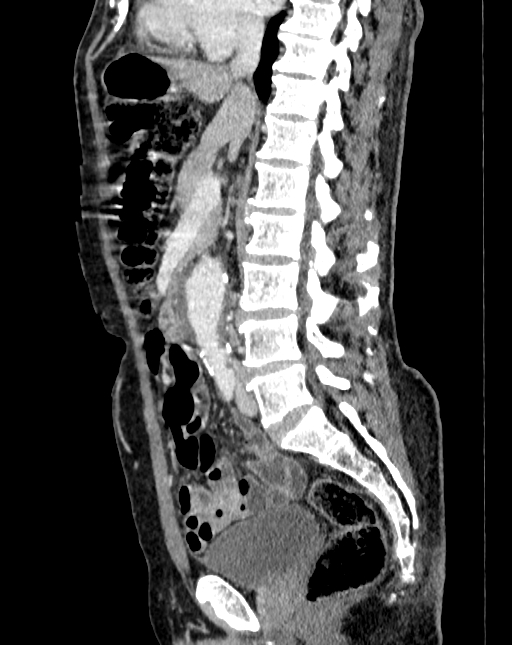 Abdominal aortic aneurysm (Radiopaedia 83581-98689 Sagittal C+ portal venous phase 43).jpg
