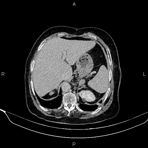 Abdominal aortic aneurysm (Radiopaedia 85063-100606 Axial C+ delayed 7).jpg