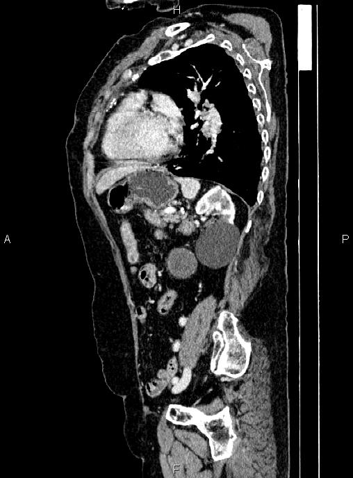 Abdominal aortic aneurysm (Radiopaedia 85063-100606 Sagittal C+ arterial phase 58).jpg