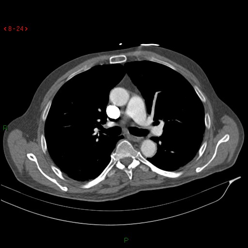 File:Abdominal aortic aneurysm rupture with aortocaval fistula (Radiopaedia 14897-14841 Axial C+ arterial phase 24).jpg