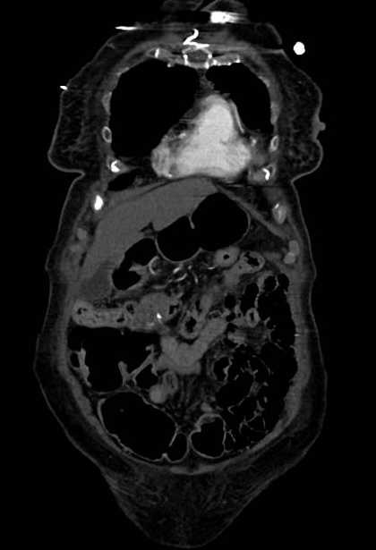 Abdominal aortic aneurysm with thrombus fissuration (Radiopaedia 73192-83919 Coronal C+ arterial phase 7).jpg