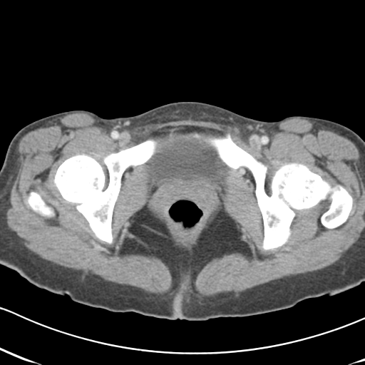 File:Abdominal desmoid tumor (Radiopaedia 41007-43740 Axial C+ portal venous phase 71).png