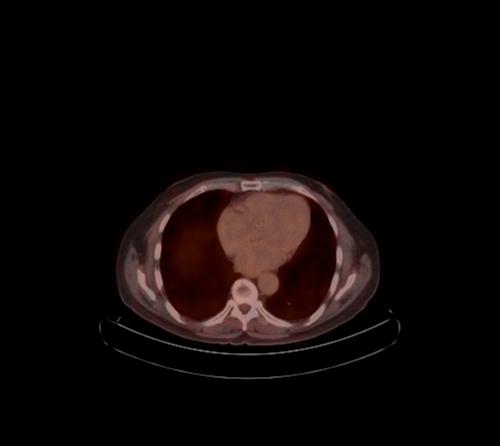 Abdominal wall metastasis from colorectal carcinoma (Radiopaedia 31016-31719 C 100).jpg