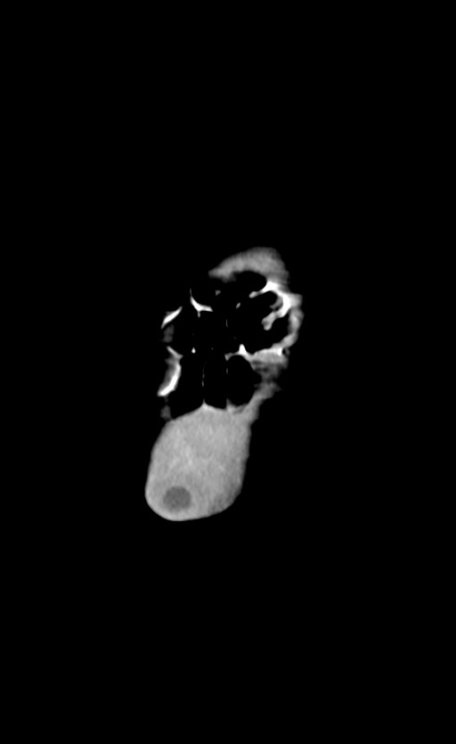 Abdominopelvic rhabdomyosarcoma (Radiopaedia 78356-90984 Coronal C+ portal venous phase 4).jpg