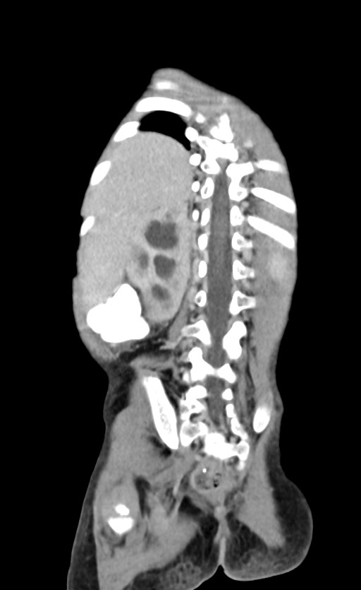 Abdominopelvic rhabdomyosarcoma (Radiopaedia 78356-90984 Coronal C+ portal venous phase 77).jpg