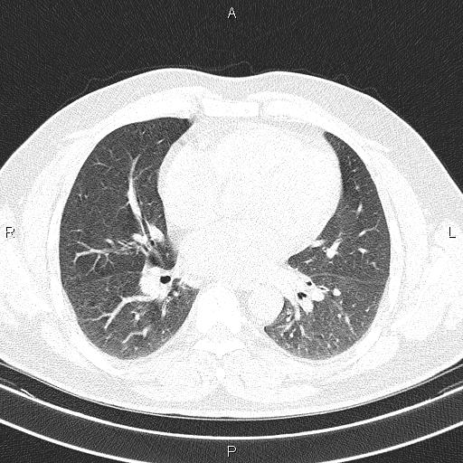 File:Aberrant right subclavian artery (Radiopaedia 87093-103354 Axial lung window 63).jpg