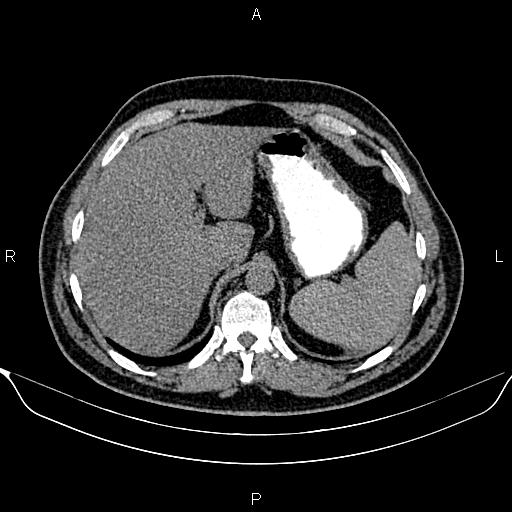 Aberrant right subclavian artery (Radiopaedia 87093-103354 Axial non-contrast 107).jpg