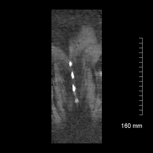 Aberrant right subclavian artery stenosis (Radiopaedia 52656-58670 B 81).jpg