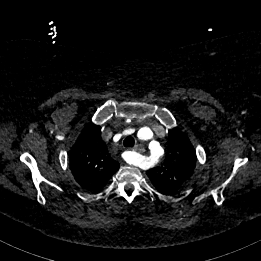 File:Aberrant right subclavian artery with Kommerell diverticulum (Radiopaedia 47982-52769 Axial C+ arterial phase 19).png