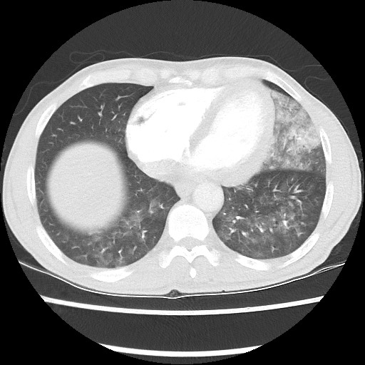 Accessory left horizontal fissure with lingular pneumonia (Radiopaedia 53763-59843 Axial lung window 41).jpg