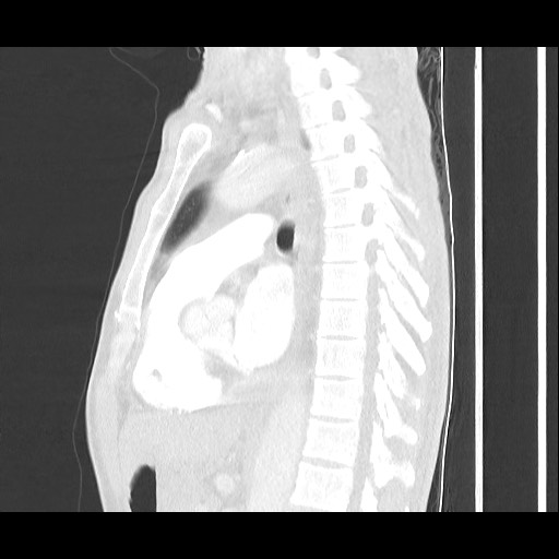 Accessory left horizontal fissure with lingular pneumonia (Radiopaedia 53763-59843 Sagittal lung window 38).jpg