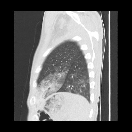 Accessory left horizontal fissure with lingular pneumonia (Radiopaedia 53763-59843 Sagittal lung window 58).jpg