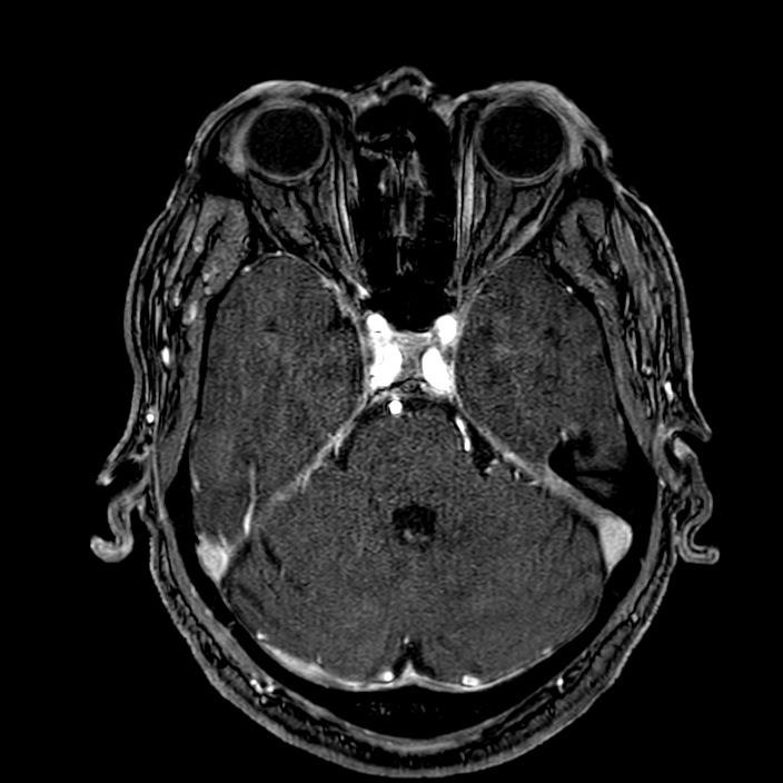 Accessory middle cerebral artery (Radiopaedia 73114-83828 Axial MRA 52).jpg