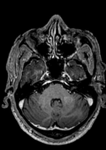 File:Accessory middle cerebral artery (Radiopaedia 73114-83828 Axial T1 C+ 124).jpg