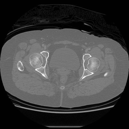 File:Acetabular fracture (Radiopaedia 13193-13212 Axial bone window 29).jpg