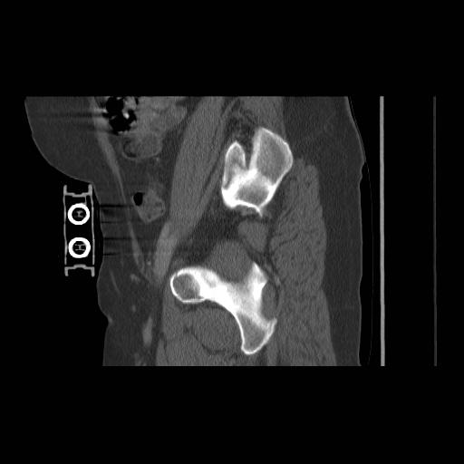 File:Acetabular fracture (Radiopaedia 13193-13212 Sagittal bone window 29).jpg
