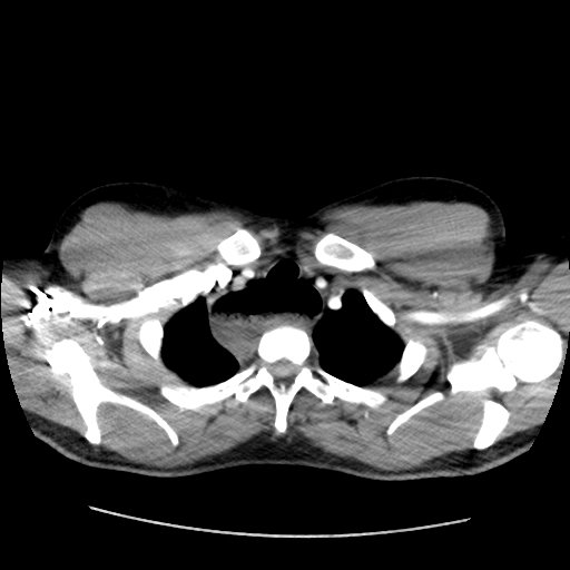 Achalasia (Radiopaedia 52507-58417 Axial bone window 8).jpg