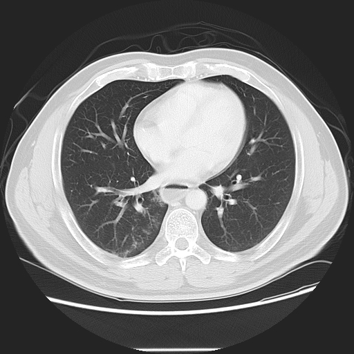 Achalasia (Radiopaedia 8831-9629 Axial lung window 38).jpg