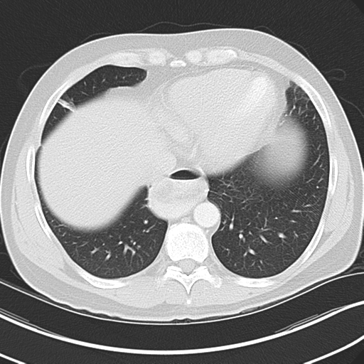 Achalasia of the cardia (Radiopaedia 38497-40595 Axial lung window 40).png