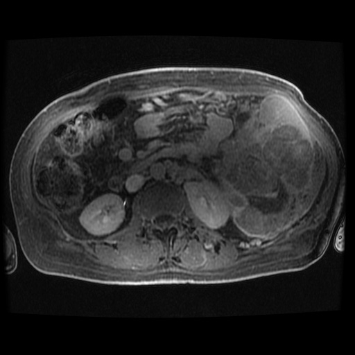 Acinar cell carcinoma of the pancreas (Radiopaedia 75442-86668 Axial late phase (~30 mins) 34).jpg