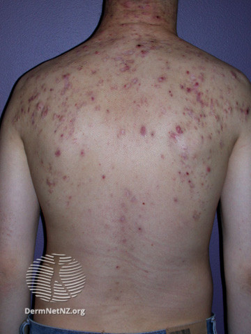 File:Acne affecting the back images (DermNet NZ acne-acne-back-169).jpg
