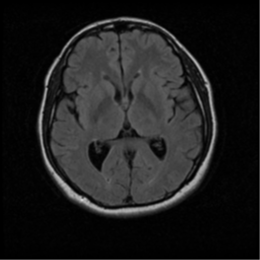 File:Acoustic schwannoma (Radiopaedia 33045-34060 Axial FLAIR 11).png