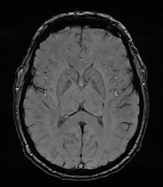 Acoustic schwannoma (Radiopaedia 50846-56358 Axial SWI 50).png