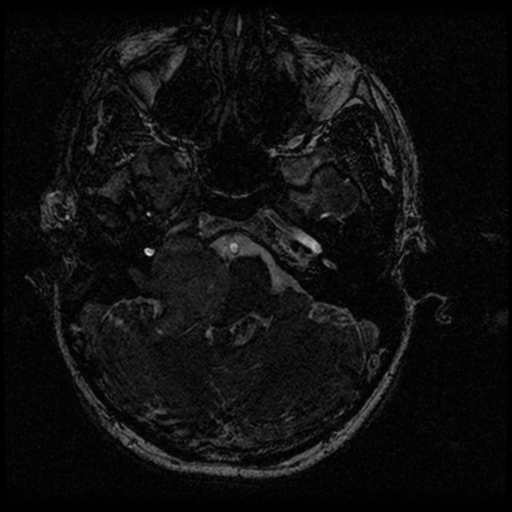 Acoustic schwannoma - eroding petrous apex (Radiopaedia 39674-42004 Axial T2 21).png