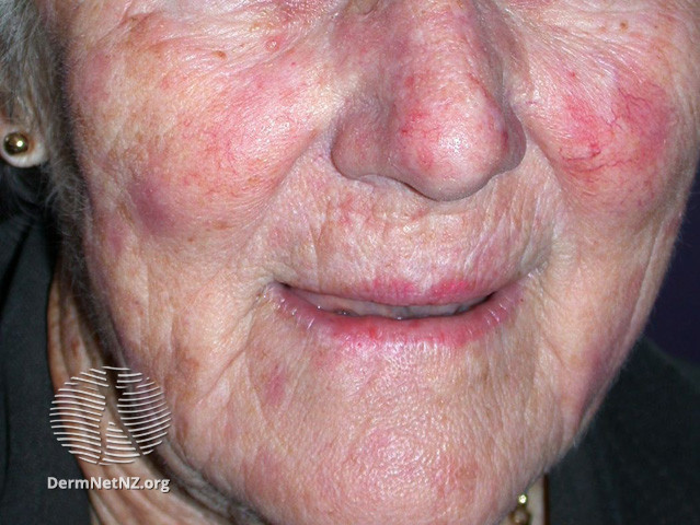 File:Actinic Keratoses treated with imiquimod (DermNet NZ lesions-ak-imiquimod-3756).jpg