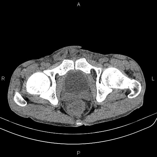 Active crohn disease (Radiopaedia 87133-103397 Axial non-contrast 100).jpg