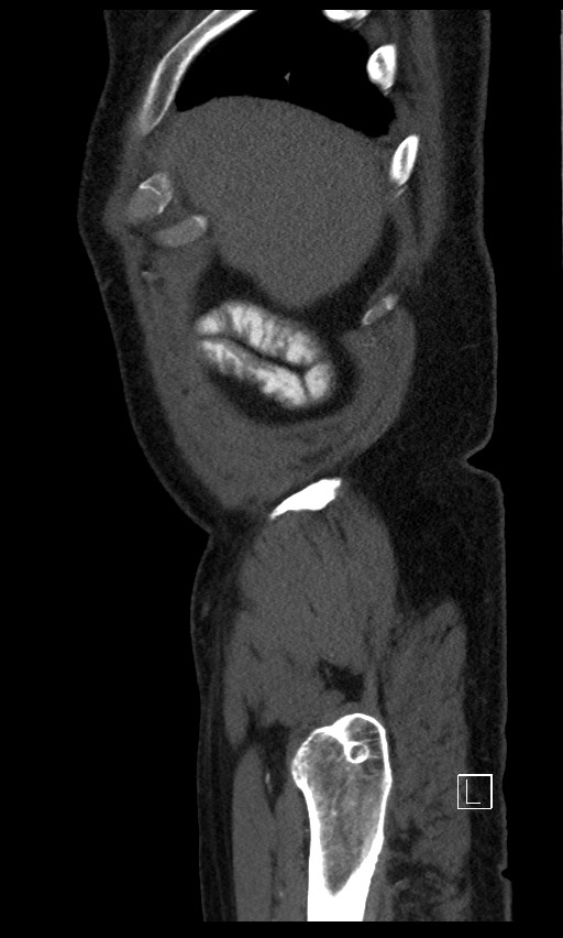Active lower gastrointestinal bleeding - diverticular (Radiopaedia 61203-69106 Sagittal C+ arterial phase 147).jpg