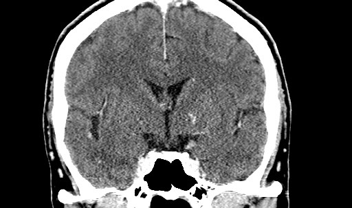 File:Active neurocysticercosis before and after therapy (Radiopaedia 71710-82099 Coronal C+ delayed 37).jpg