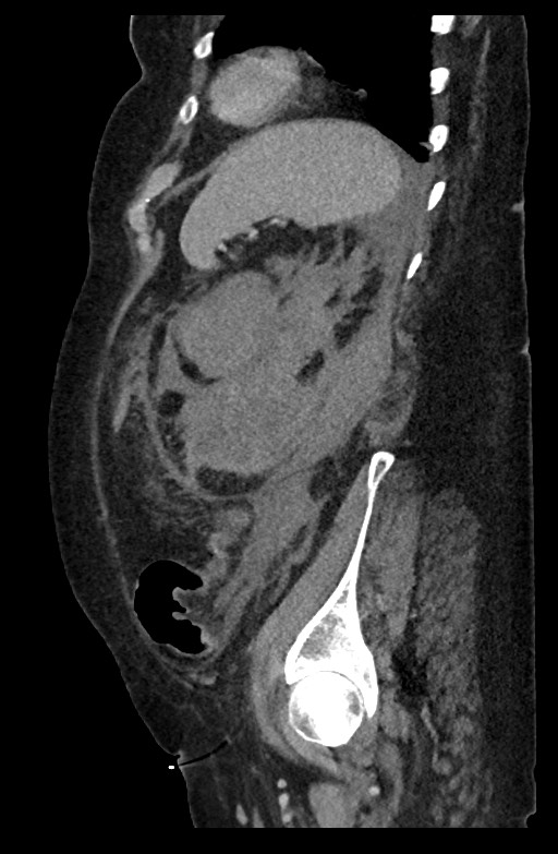 Active renal extravasation with large subcapsular and retroperitoneal hemorrhage (Radiopaedia 60975-68796 Sagittal C+ portal venous phase 68).jpg