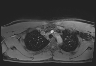 File:Active right ventricular cardiac sarcoidosis (Radiopaedia 55596-62100 Axial Post contrast Dixon 8).jpg