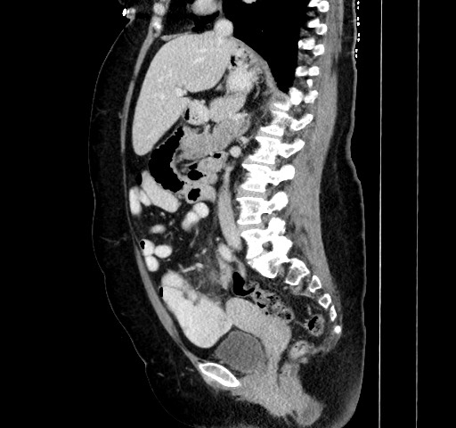 Acute appendicitis, heterotaxy syndrome (Radiopaedia 66884-76202 Sagittal C+ portal venous phase 63).jpg