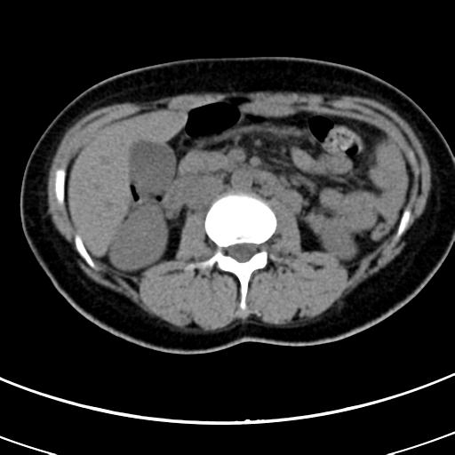 Acute appendicitis (Radiopaedia 30261-30888 Axial non-contrast 30).jpg