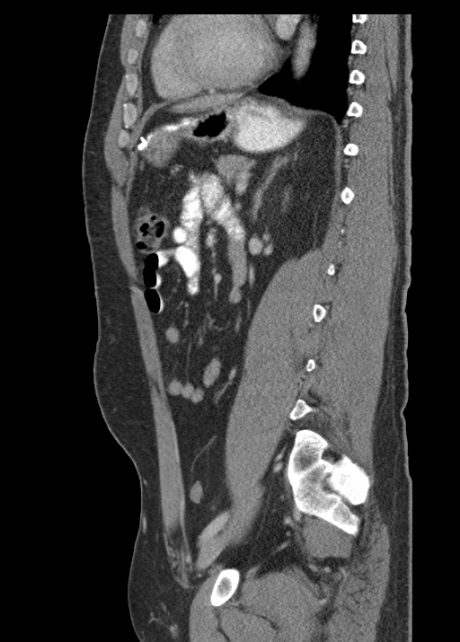 Acute appendicitis (Radiopaedia 48511-53463 Sagittal C+ portal venous phase 85).jpg