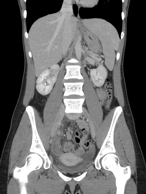 Acute appendicitis (Radiopaedia 62608-70901 Coronal C+ portal venous phase 26).jpg