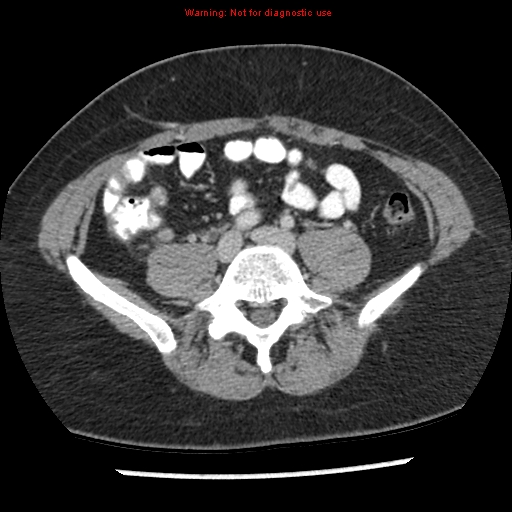File:Acute appendicitis (Radiopaedia 7966-8812 C+ portal venous phase 33).jpg