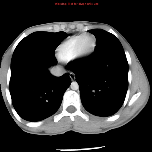 Acute appendicitis (Radiopaedia 8195-9045 Axial C+ portal venous phase 3).jpg