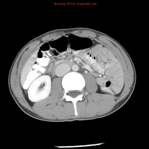 Acute appendicitis (Radiopaedia 8195-9045 Axial C+ portal venous phase 34).jpg