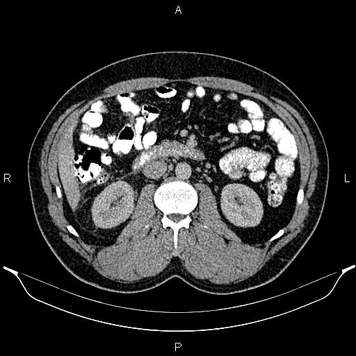 File:Acute appendicitis (Radiopaedia 84780-100240 Axial C+ portal venous phase 47).jpg