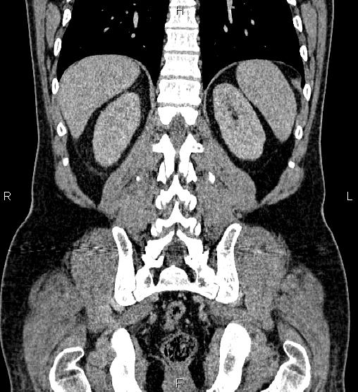 Acute appendicitis (Radiopaedia 84780-100240 Coronal C+ portal venous phase 63).jpg