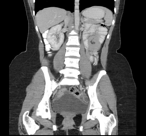 File:Acute appendicitis (Radiopaedia 9417-10099 Coronal C+ portal venous phase 1).jpg