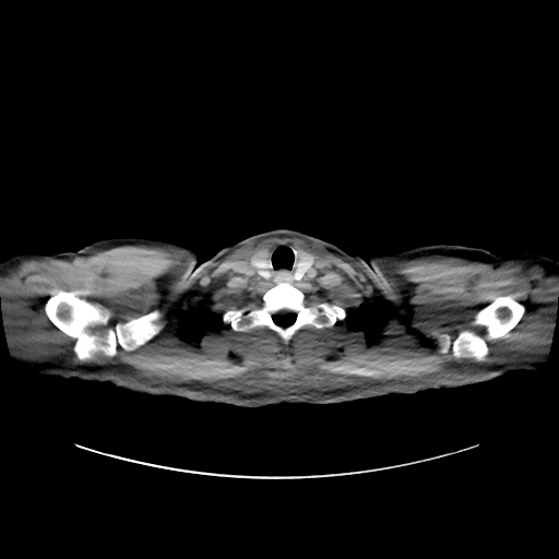 Acute appendicitis and COVID 19 pneumonia (Radiopaedia 76604-88380 Axial non-contrast 2).jpg