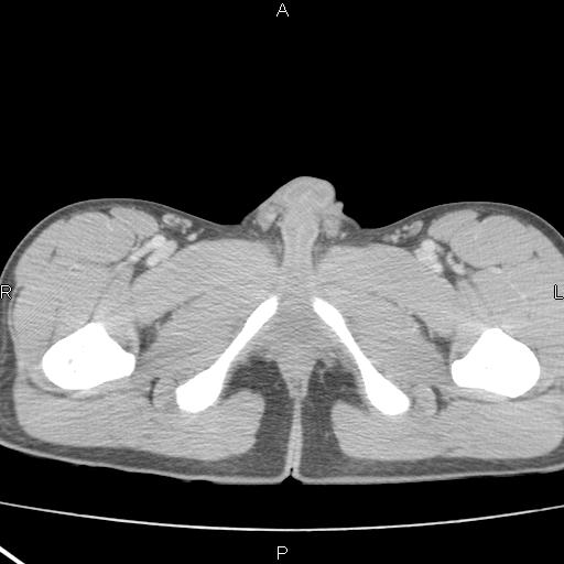 File:Acute appendicitis with CT arrowhead sign (Radiopaedia 21474-21411 Axial C+ portal venous phase 44).jpg