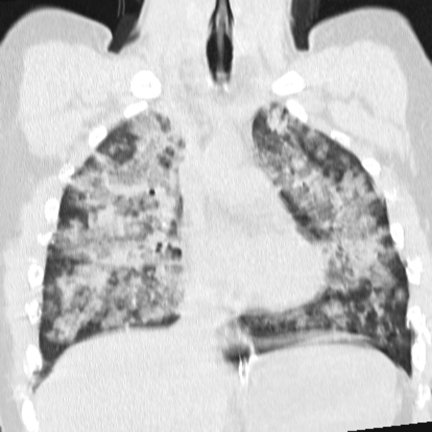 Acute aspiration pneumonitis (Radiopaedia 33605-34703 Coronal lung window 40).jpg