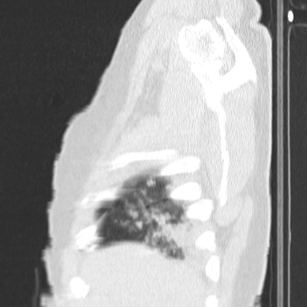 Acute aspiration pneumonitis (Radiopaedia 33605-34703 Sagittal lung window 12).jpg