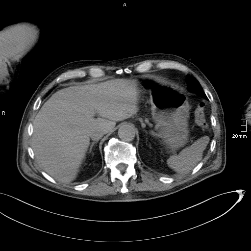 Acute aspiration pneumonitis (Radiopaedia 55642-62166 Axial liver window 57).jpg